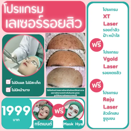 รีวิวเลเซอร์รอยสิว โคราช ภาพเปรียบเทียบก่อนและหลังรักษารอยแดงรอยดำ วรวลัญช์ คลินิก