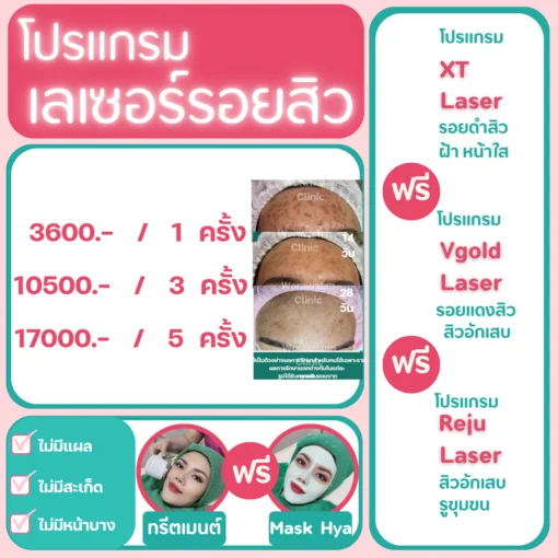 ราคาเลเซอร์รอยสิว โคราช โปรแกรม XT Laser และ Vgold Laser รักษารอยแดงรอยดำสิว