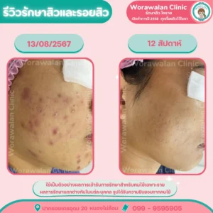 รีวิวรักษาผิวติดสาร โคราช วรวลัญช์ คลินิก ซอยเดชอุดม 20