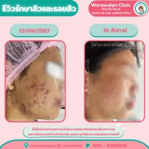 รีวิวเลเซอร์รอยดำสิว โคราช วรวลัญช์ คลินิก หน้าใสขึ้น