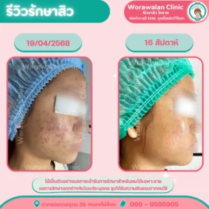 ทรีตเมนต์รักษาสิว โคราช ปรับผิวเนียนนุ่มชุ่มชื้น