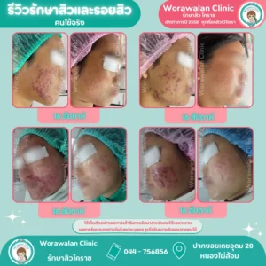รีวิวรักษาสิวอุดตันหัวปิด โคราช วรวลัญช์ คลินิก