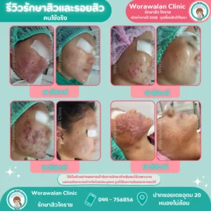 คลินิกรักษาสิวโคราช หมอเจี๊ยบ รักษาเฉพาะสิวเห็นผลจริง