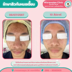 รีวิวรักษาสิวฮอร์โมน โคราช วรวลัญช์ คลินิก สิวหายจริง