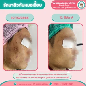 รีวิวรักษาสิวหัวช้าง โคราช วรวลัญช์ คลินิก หมอทำเอง