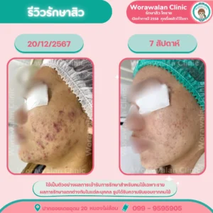 รีวิวรักษาสิวและรอยสิวโคราช วรวลัญช์ คลินิก หนองไผ่ล้อม