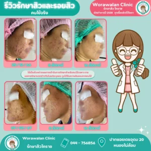 รีวิวเลเซอร์รอยสิว โคราช หมอตรวจรักษาและทำเลเซอร์เองทุกเคส